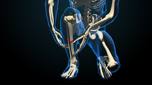 3D人体医疗骨折20秒视频