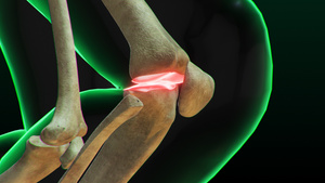 3D人体医疗膝关节半月板损伤疾病展示20秒视频