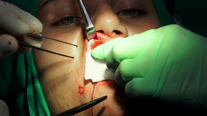 口腔外科用手术针缝合伤口27秒视频