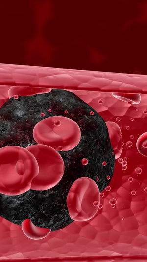 血液垃圾形成的血栓脱落后堵塞血管红细胞10秒视频