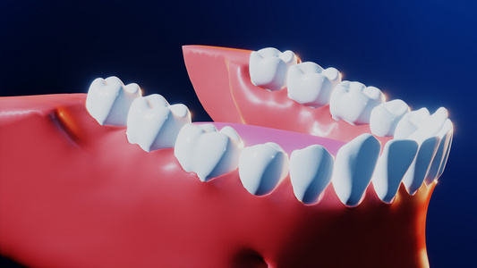 牙科植牙术手术程序视频