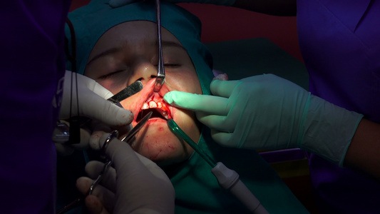 在暗室做口腔外科手术医生在黑暗房间进行口腔手术视频