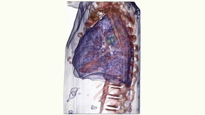 肺癌的图形重建15秒视频