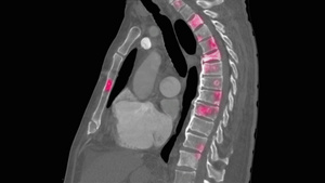 脊柱转移性病变11秒视频