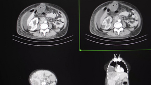 对女性病人胸部和腹部的Ct扫描19秒视频