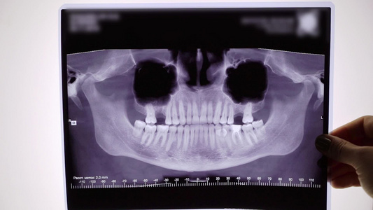 牙齿和下巴的X光胶片视频