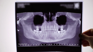 牙齿和下巴的X光胶片8秒视频