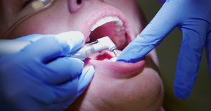 牙医检查病人的牙齿20秒视频
