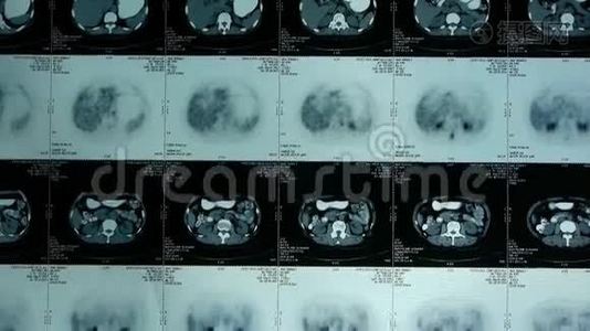 动人体器官pet-ct扫描，淋巴结X线，肿瘤转移..视频