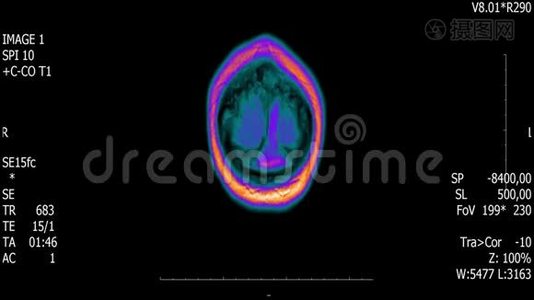 真实生命人脑核磁共振扫描与肿瘤医学研究新质量健康科学4k镜头股票动画视频
