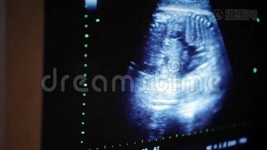 孕妇产科超声胎儿视频