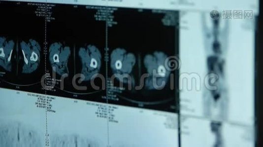 人眼影&骨PET-ct扫描，X线，肿瘤转移..视频