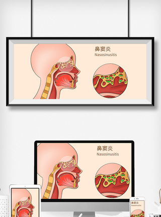 鼻窦炎科普医疗插画图片