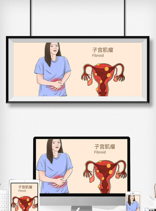 生病女人子宫肌瘤科普医疗插画模板