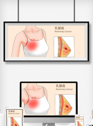 女性胸部乳腺癌科普医疗插画模板