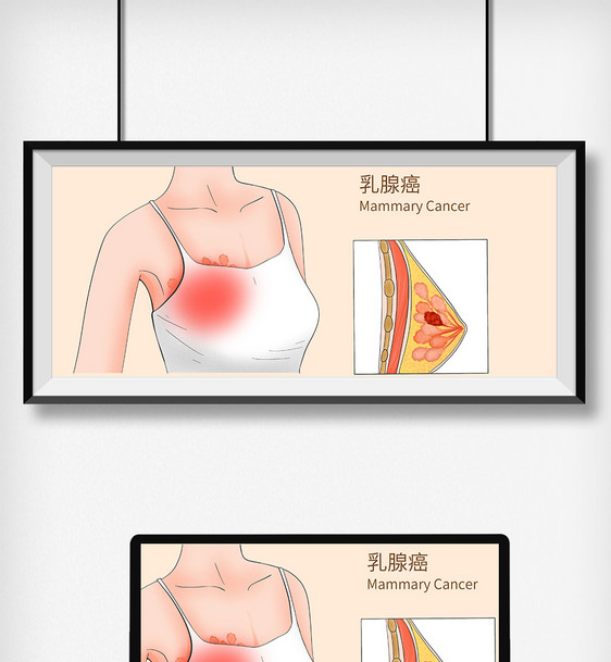 乳腺癌科普医疗插画图片