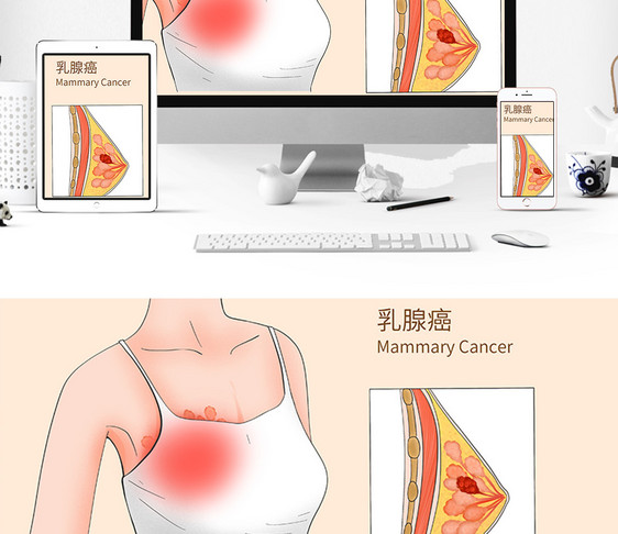 乳腺癌科普医疗插画图片