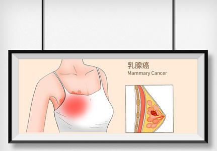 乳腺癌科普医疗插画图片