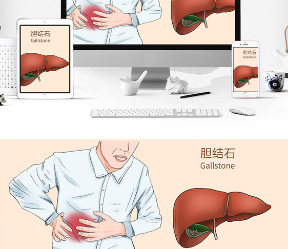 胆结石科普医疗插画图片