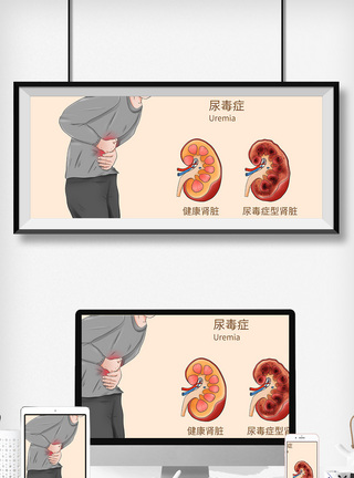 尿毒症科普医疗插画图片