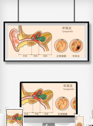 炎症中耳炎科普医疗插画模板