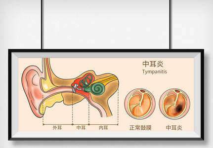 中耳炎科普医疗插画图片