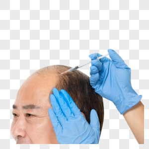 医生给中年大叔治疗秃头图片
