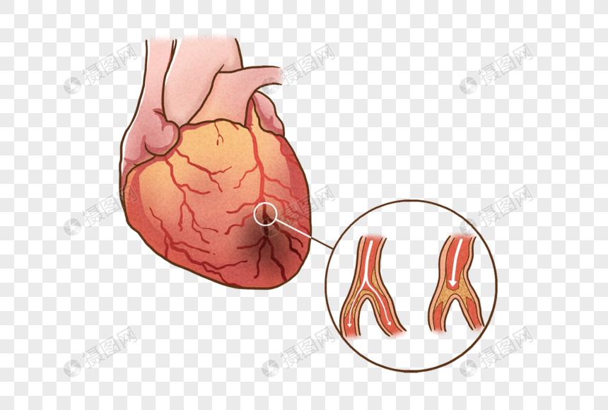 冠心病图片