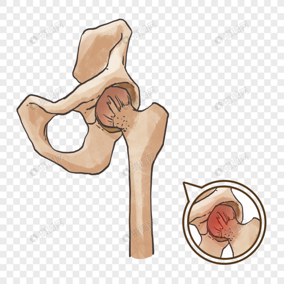 髋关节炎图片