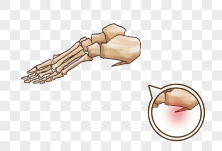 足跟骨刺骨科病足跟痛高清图片