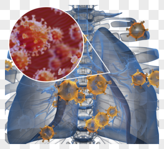 新冠状病毒性肺炎图片