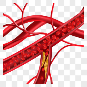 人体血管胆固醇堵塞动脉医学插图图片