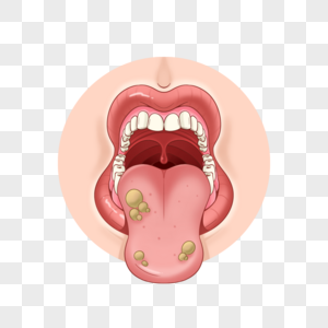 口腔溃疡医学粘膜炎症高清图片