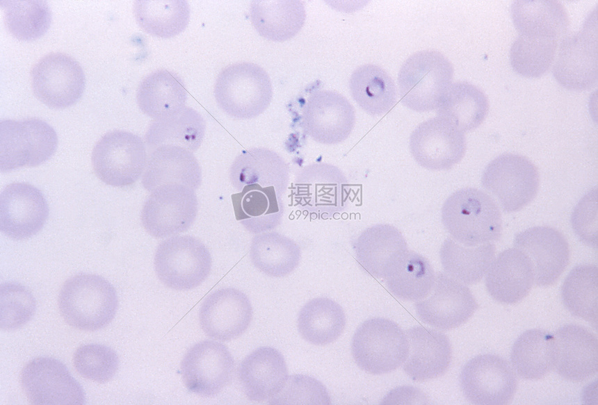 这种薄膜显微照片显示5恶性疟原虫环; 4一个质点,并且