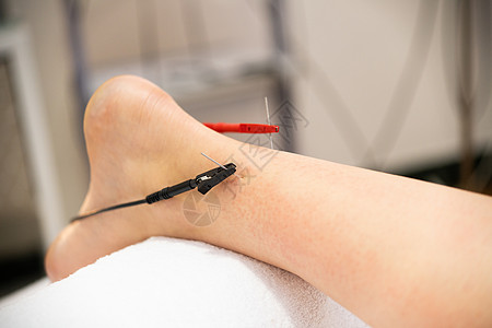电针干针连接机物理治疗中的电刺激电针干燥与针头连接机背景图片