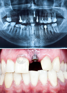 口腔内种植牙的观镜头及其全景牙科图片
