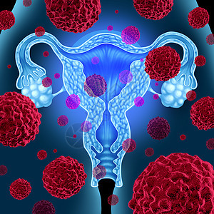 子宫子宫癌医学癌细胞女体内扩散,攻击生殖系统解剖,包括卵巢输卵管,宫颈癌生长治疗风险的保健标志图片