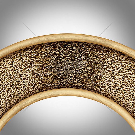 骨病的,骨软化骨穿化种医学解剖符号,种弱化变形的海绵状骨架,由于骨的软化,多孔的弱骨骼结构图片