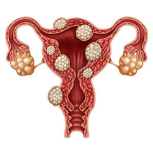 系统子宫肌瘤医学人类女生殖子宫疾病的象征背景