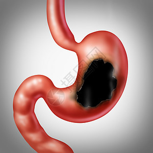 胃溃疡的医学燃烧消化系统消化良疼痛与个医学插图的人腹部器官与个洞烧伤与烟雾个保健符号三维插图风格图片