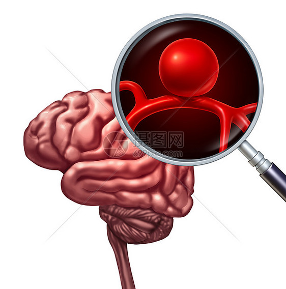 脑动脉瘤脑动脉瘤医学障碍的,人类思维器官的放大,血管的炎症符号破裂的风险三维图示图片