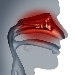 鼻息肉医学种非癌肿胀生长的人类鼻窦充血症状符号三维插图风格图片
