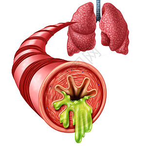 支气管炎解剖支气管衬里的种炎症,厚厚的粘液分泌为胸冷三维插图元素图片