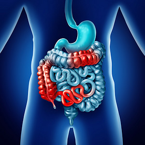 克罗恩病肠道疾病克罗恩病的医学人类消化结肠与炎症症状引梗阻三维插图图片