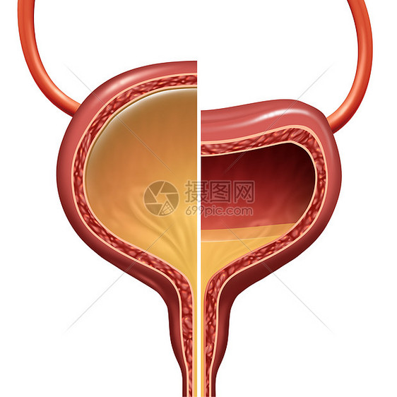 膀胱种正常过度活跃的泌尿器官比较,代表了自主的尿液丢失,种健康健康的情况与三维插图元素图片