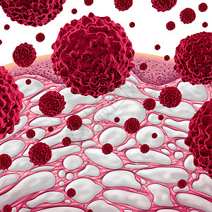 间质癌症结缔,与填充液体的比较个微观的人体部分与恶细胞三维插图风格间质癌症图片