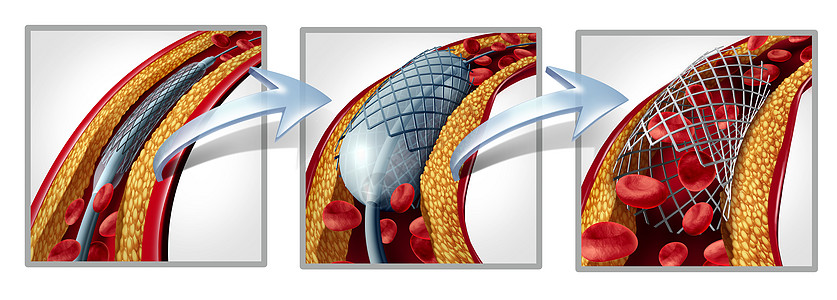 冠状动脉支架血管成形术的种心脏病治疗符号图,与植入过程的阶段动脉,胆固醇斑块堵塞被打开,以增加血流量三维图图片
