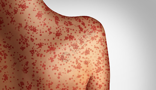麻疹种致命的爆发免疫,疾病病疾病种传染水痘皮疹的三维插图风格背景图片