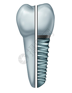 牙科种植牙骨内牙假体与正畸冠切除金属螺钉白色背景上分离的牙齿骨内牙假体的比较,正畸牙科手术象的三维插图背景图片