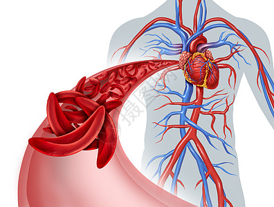 镰状细胞心脏循环阻塞贫血种正常异常血红蛋白的疾病,人体动脉解剖中心脏心血管医学图示的,三维图示元素图片